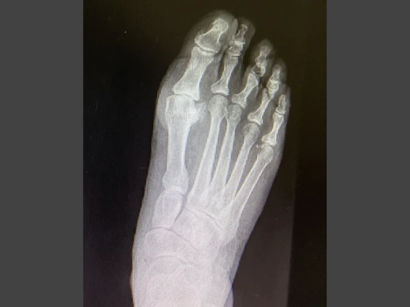 Radiografia alluce rigido prima dell'intervento