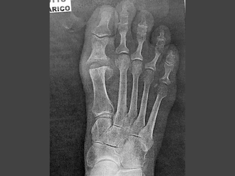 Radiografia alluce rigido dopo l'intervento