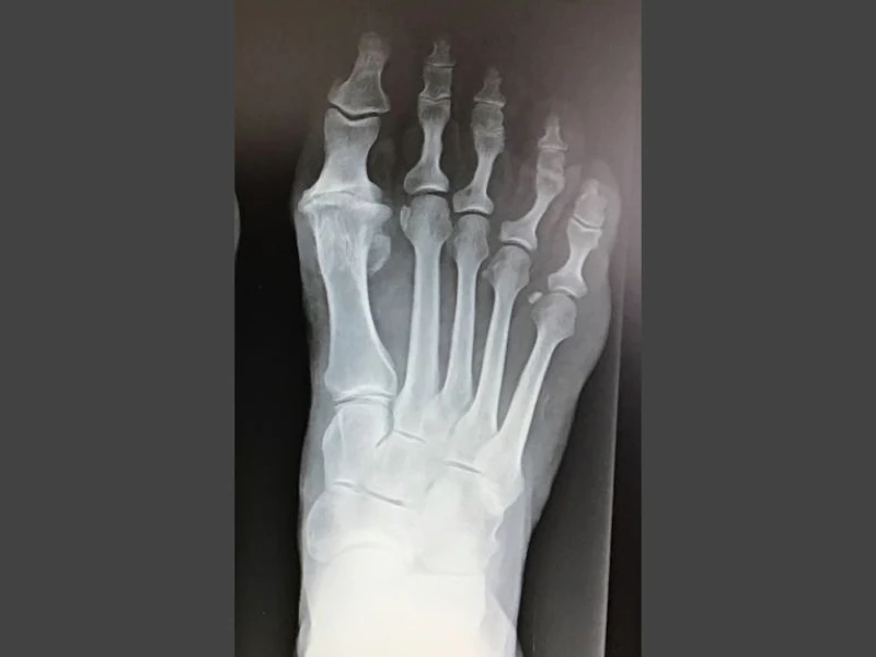 Radiografia alluce rigido prima dell'intervento