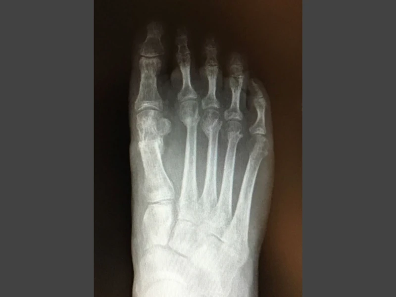 Radiografia alluce valgo dopo l'intervento