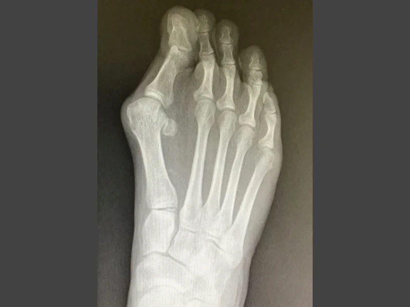 Radiografia alluce valgo prima dell'intervento