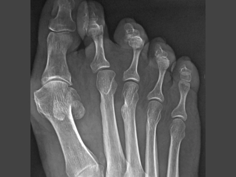 Radiografia alluce valgo con metatarsalgia prima dell'intervento